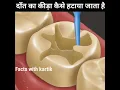Download Lagu 🦷दाँत का कीड़ा कैसे हटाते हैं👨‍⚕ by Animation #shorts #shortvideo