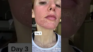 نتيجة استخدام التقشير البارد كوزميلان خلال    ايام دندنها