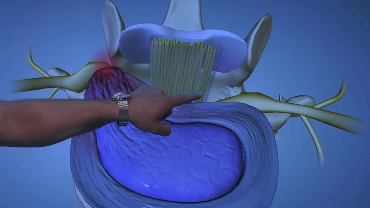 Dr. Ebraheim's educational animated video describes clinical test for lower back pain. Become a frie. 
