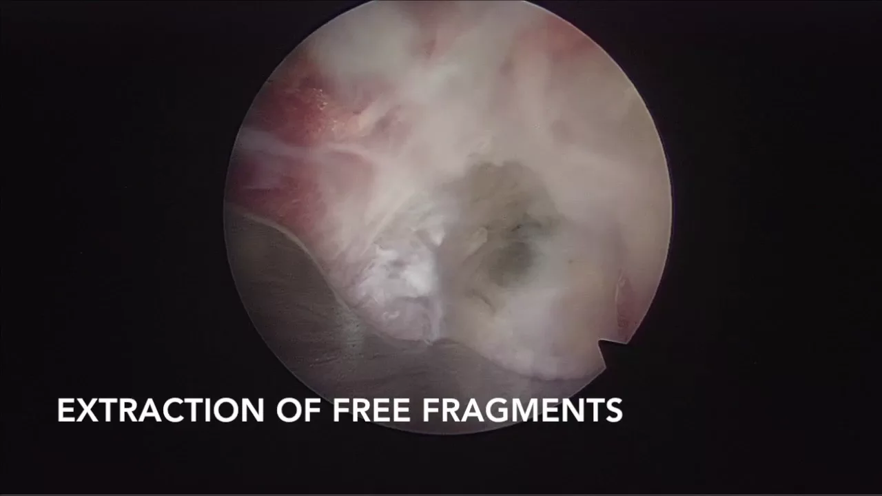 ?? Do You Have a Herniated Disk: 3 Quick Tests You Can Try.. 
