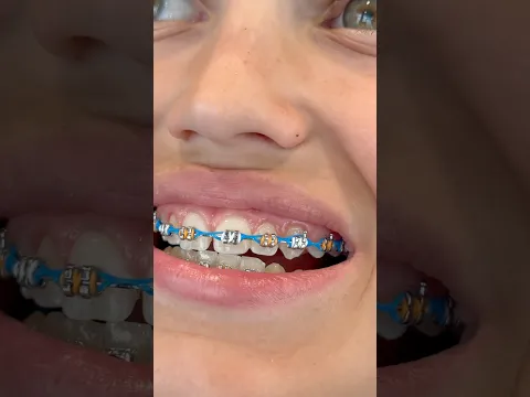 New York Knicks Braces Colors 🏀 #braces