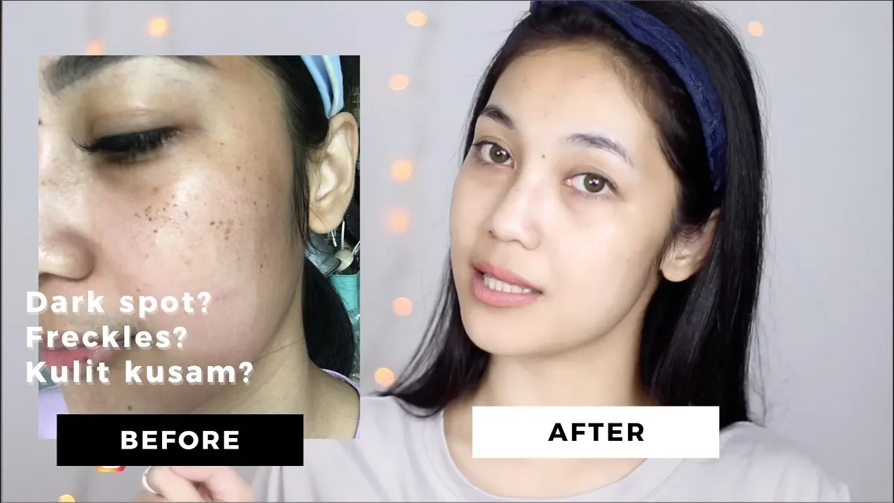 Keratosis Seboroik di Kelopak Mata? | On the Spot Laser CO2 & Harga dr. Irfan Prasetya. 