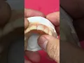 Single Anterior Nesbit Partial EnvisiontecMain