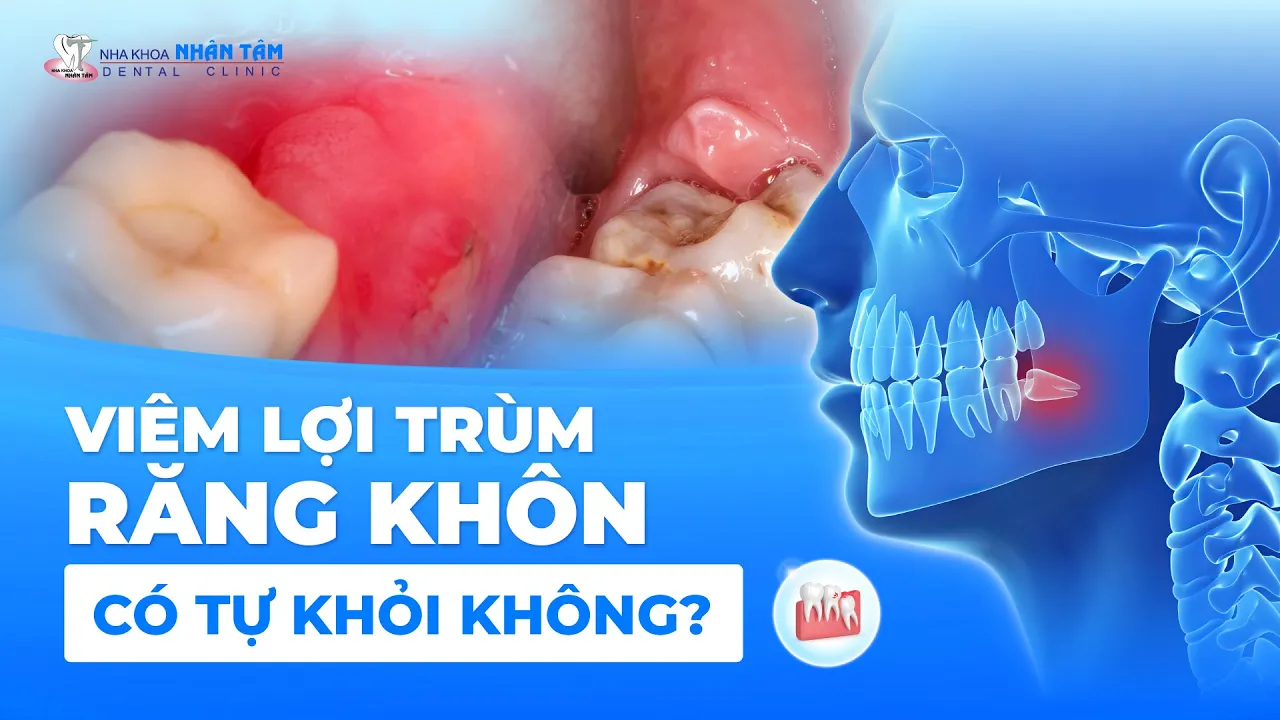 Outline Video VIÊM LỢI TRÙM RĂNG KHÔN CÓ TỰ KHỎI KHÔNG? | NHA KHOA NHÂN TÂM
