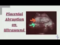 Placental Abruption Management Placental Abruption Treatment