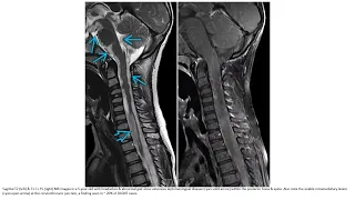 Download Diffuse Leptomeningeal Glioneuronal Tumor Imaging MP3