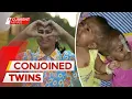 Conjoined twins life after being separated A Current Affair