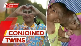 Conjoined twins life after being separated A Current Affair