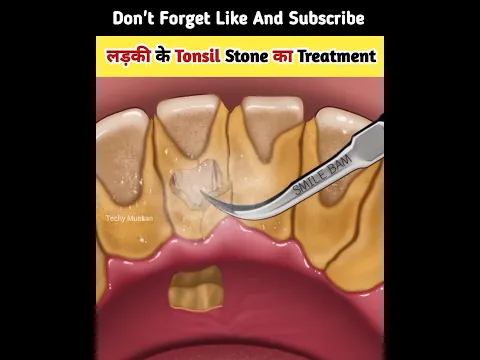 लड़की के Tonsil Stone का Treatment #asmr #shortsvideo