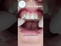 Download Lagu Clear Aligners - This is how you put them 🦷#aligner #dentist #dental #teeth #clearaligners