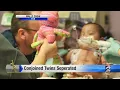 Anniversary of separating conjoined twins