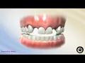 Missing Lateral Incisor