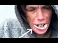 This Is A BAD Case Of Oral Thrush