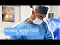REVERSE TUMMY TUCK SURGERY Dr Zuri Plastic Surgery