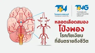 หลอดเลือดสมองโปร่งพองคืออะไร และเกิดขึ้นได้กับใครบ้าง