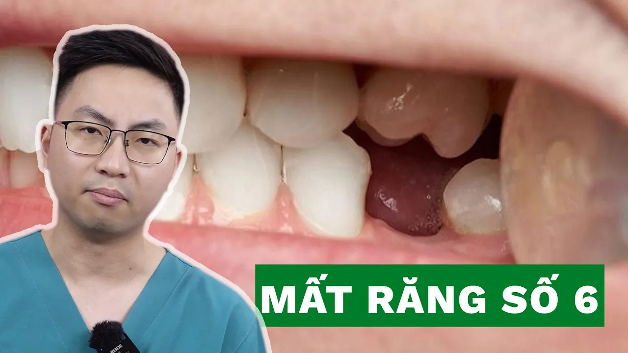 Outline Video ✅ Mất Răng Số 6 Có Niềng Được Không? | DR DEE