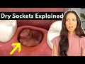 Blood Clots Are GOOD Dry Sockets Explained