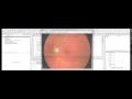 Project based learning - Automatic Classification of the Diabetes Retina image based on SVM algorithm