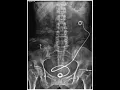 Dilation of nephrostomy CPT code - simplify medical coding