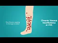 What is Chronic Venous Insufficiency CVI