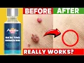 Paradise Skin Tag Mole Remover Does It Really Work Watch This Honest Review Find Out Right Now