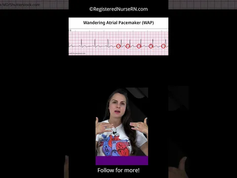ECG NCLEX Quiz Question & Rationale  #nursing #nurse