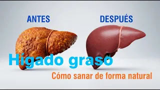 ¿Hígado graso? 7 cambios que sí ayudan y 3 mitos