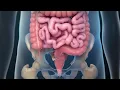 Colorectal Cancer Surgery Rectum Removal