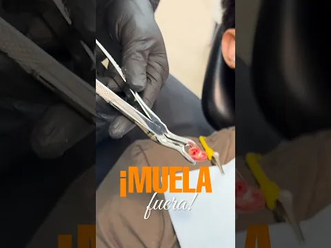 Video real de la extraccion MUELA del JUICIO semiretenida con cirugía.
