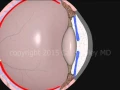 Cataract Surgery phacoemulsification by Cal Shipley M D