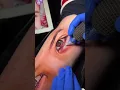 Eye tattoo - EMALLA Cartridge
