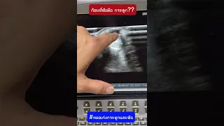  ทำไมมือถึงมีก้อนนูนและเจ็บปวด ทั้งที่ไม่ใช่กระดูก 