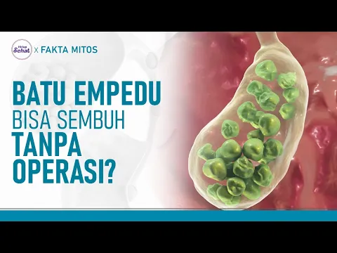 Apakah Batu Empedu Bisa Sembuh Tanpa Operasi?