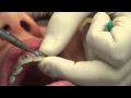 Download Putting Braces on mp4 3gp mp3 videos - waplic