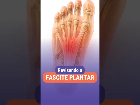 REVISANDO A FASCITE PLANTAR 🦶