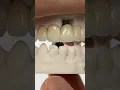 Download Lagu Monet Pure #Zirconia Incisors #dental #teeth #smile #lsk121shorts #shortvideo #shorts #implants