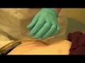 Download Lagu Dompelen PEG-sonde - Ziekenhuis Gelderse Vallei