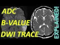 Download Lagu Diffusion Weighted Imaging EXPLAINED (DWI Trace, ADC, B-Values) | MRI Physics Course Lecture 14