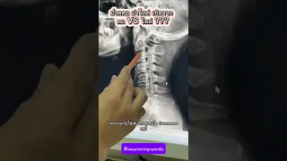 อาการปวดต้นคอแล้วร้าวลงไหล่เกิดจากสาเหตุอะไรบ้าง