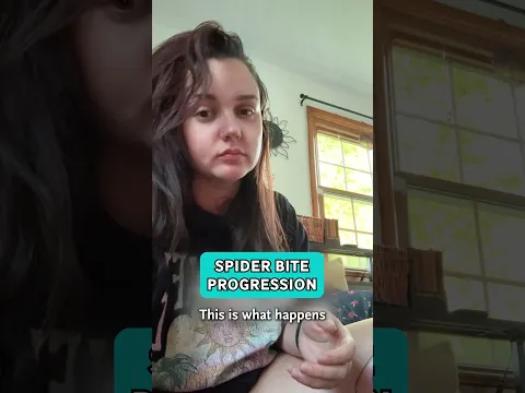 From Bite to Battle: My Spider Bite Journey 🕷️