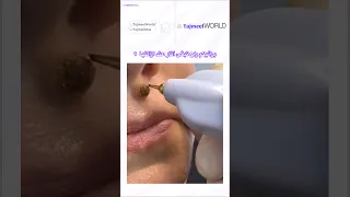 حيل ل إزالة الشامة بالليزر  كل ما تحتاج معرفته  دندنها