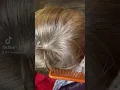 Download Lagu Visible Lice Eggs on Little Boy #lice #licetreatment #oklahomacity #licecheck