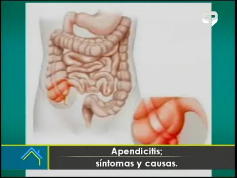 Apendicitis: Síntomas y causas