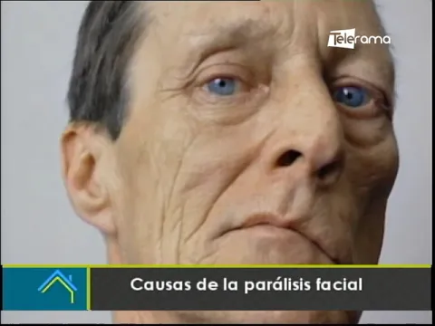 Causas de la parálisis facial