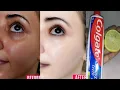 Download Lagu Colgate toothpaste for face whitening | Amazing colgate beauty hacks | Colgate and lemon face pack