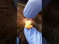 Download Lagu Pilar Cyst POP! | Dr. Derm