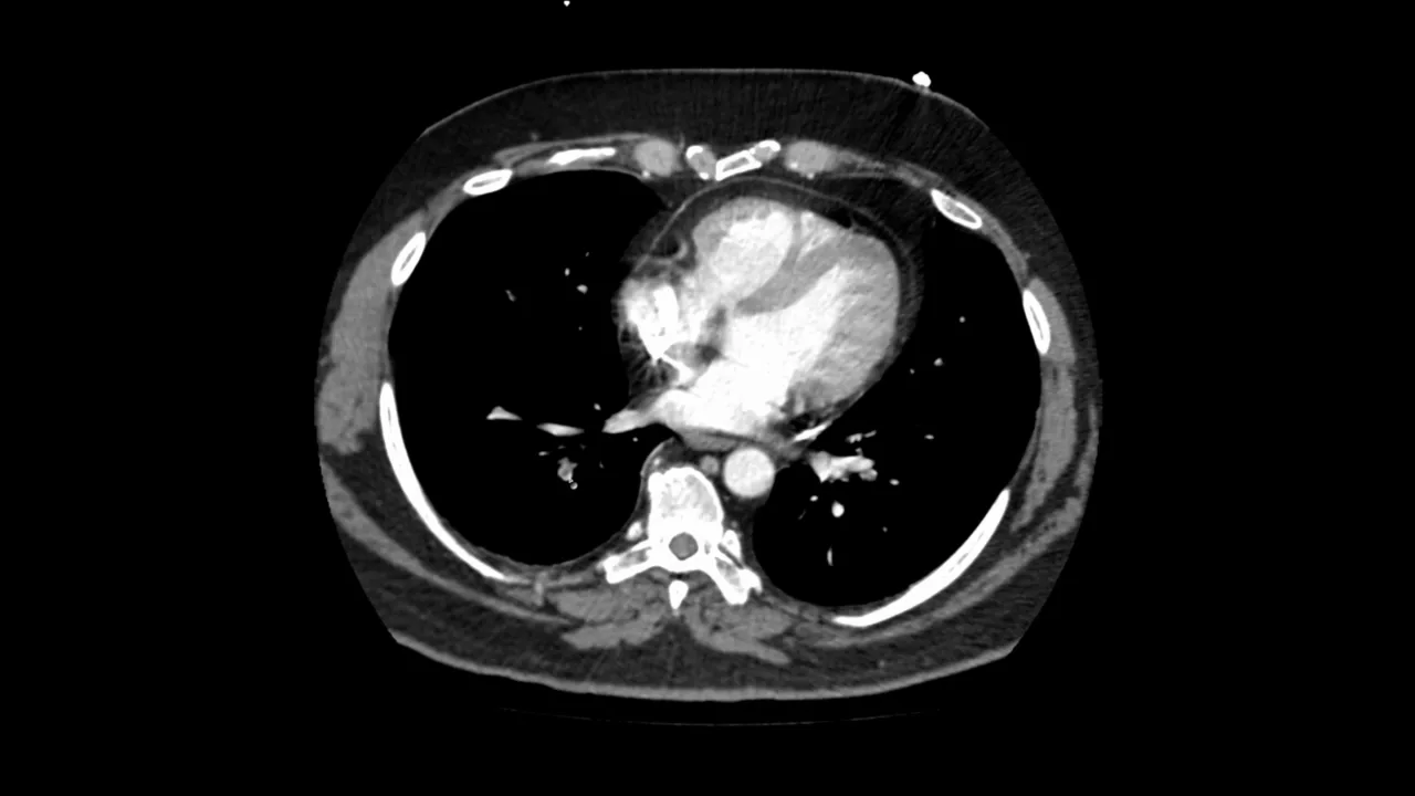 Pulmonary Embolism CTPA Interpretation! 256 Shades of Grey Episode 2