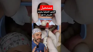 فينير الاسنان ايماكس 