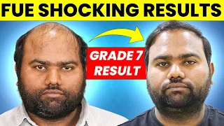 Shocking FUE Hair Transplant Results Month by Month | Hair Transplant Results 2024