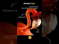 Download Lagu Fallopian Tube Blockage😳 #infertility #tubes #share